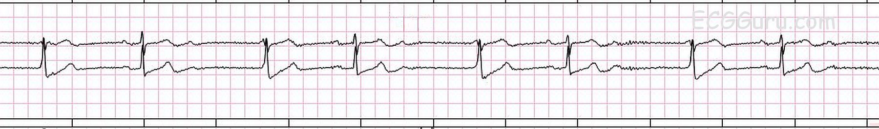 first-degree-av-block